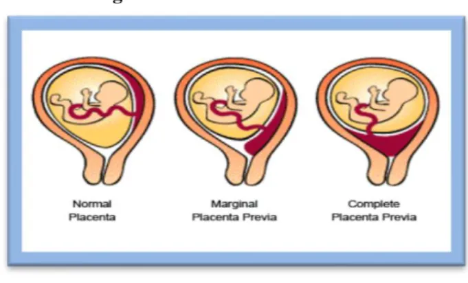 Figura N°  2. 5. Placenta Previa. 