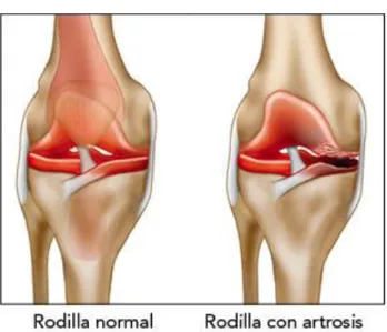 Ilustración 7 Rodilla sana y Rodilla con artrosis 