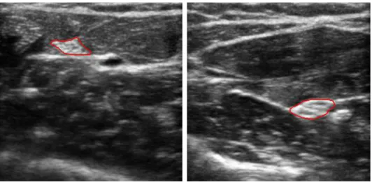 Figure 2.1: Images in the dataset UI-UTP1. In the left, the Ulnar nerve is shown, and the Median nerve is shown on the right