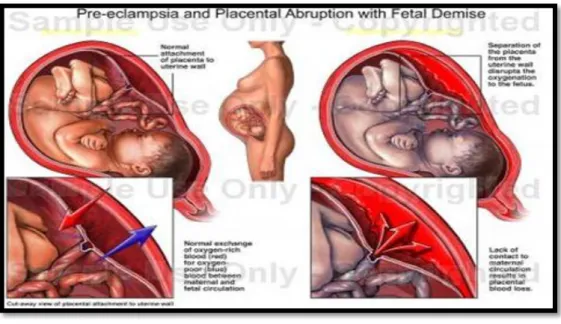 Gráfico 5.- Pre-eclamcpsia 