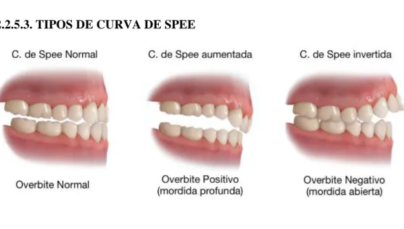 Fig. 11 Tipos Curva de Spee