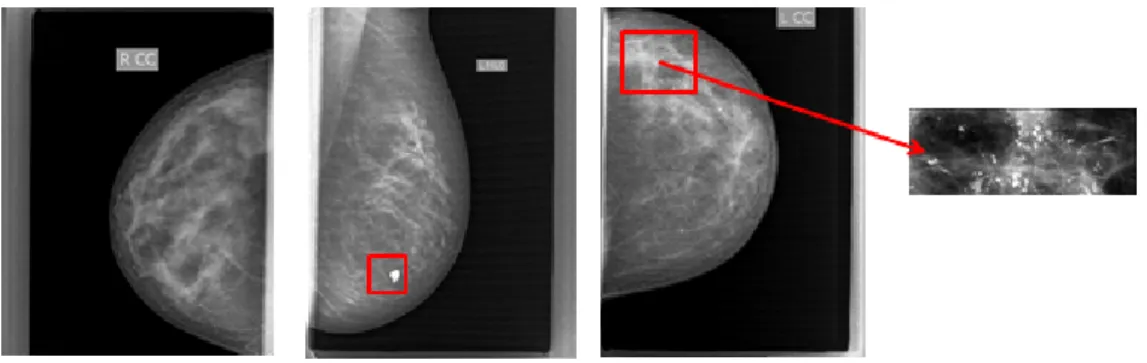 Figura 8.2: Mamografía normal, con calcificación benigna y con mcals calcificaciones