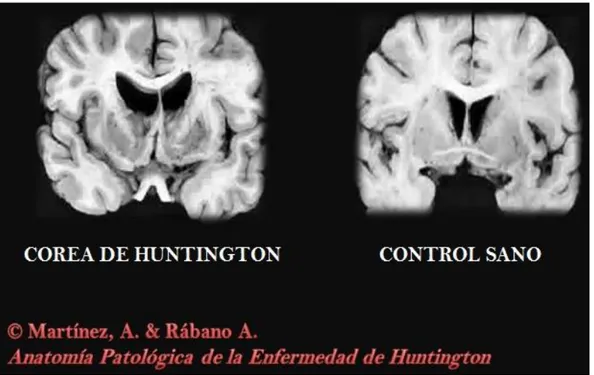 Figura 3. Anatomía patológica de la enfermedad de Huntington 