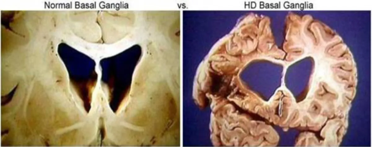 Figura 1. Normal Basal Ganglia vs HD Basal Ganglia. 