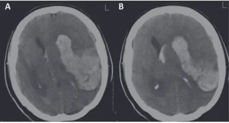 Figura 3. tac cerebral simple segunda hospitalización.