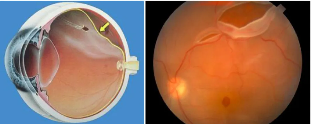 Figura 1.7Desprendimiento Retinal[22] 