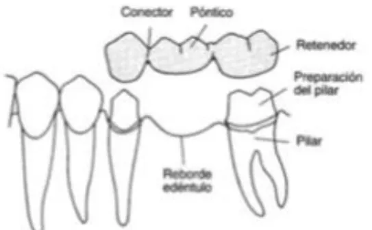 Figura 3. Componentes de la prótesis fija  (16) 
