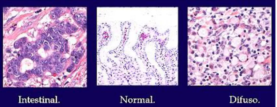 Figura 5. Clasificación histológica de Lauren del cáncer gástrico. Se aprecia en  la parte central mucosa normal, en la izquierda cáncer gástrico  tipo intestinal  que suele presentarse estructuras glandulares; a la derecha el tipo difuso en el  cual se pr