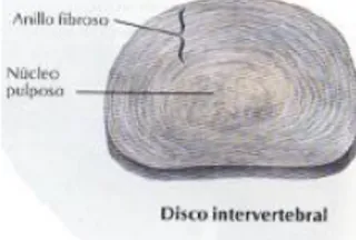 Figura 3: Disco intervertebral. Netter FH. Atlas de anatomía humana. MASSON S.A. 