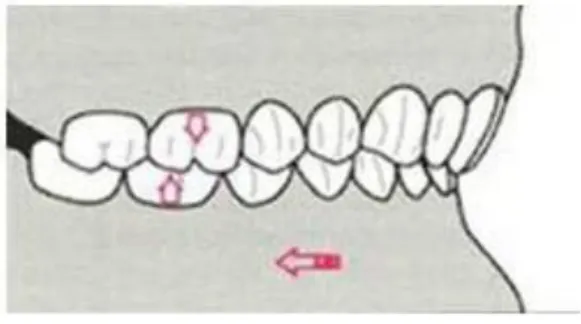 FIGURA 3. Clase Molar II división 2, Según Angle  Fuente: https://www.ortodoncia.ws/publicaciones/2015/art-3/ 