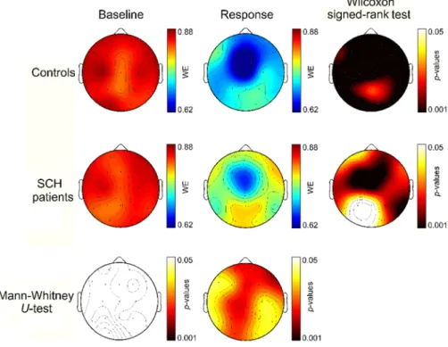 Figure 5. Sensor-level topographic maps of the statistics computed for  WE SA  between  controls and patients
