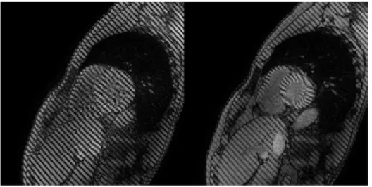 Figure 1.2: Examples of MR-T images of the heart at different cardiac phases: with no deformation at ED phase (left) and a maximal deformation at ES phase (right).