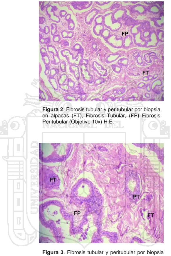 Figura  3.  Fibrosis  tubular  y  peritubular  por  biopsia  en  alpacas  (FT)  Fibrosis  Tubular,  (FP)  Fibrosis  Peritubular,  (PT)  Pérdida  de  tejido  tubular  (peritubular) (Objetivo 40x) H.E.