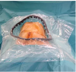 Figura 26 . Colocación del campo operatorio con bolsa de protección para recogida de fluidos de  la cavidad abdominal (equipo de cesáreas).