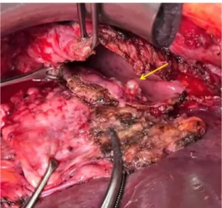 Figura 30 . Apertura del diafragma derecho y exposición del nódulo tumoral intrapleural (flecha).