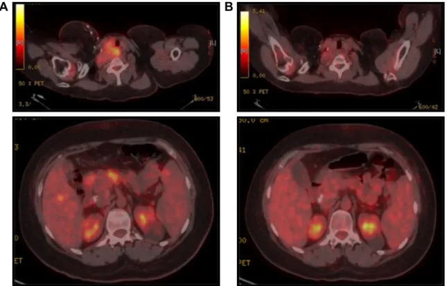 Figure 2 peT/CT scan before lenalidomide/celecoxib (A) and after six cycles of lenalidomide/celecoxib (B).