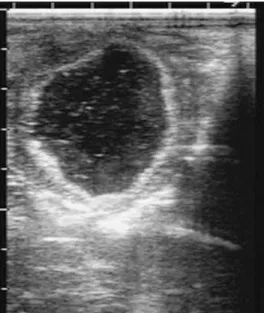 Figura 1 Imagen de ultrasonido de un folículo hemorrágico. 