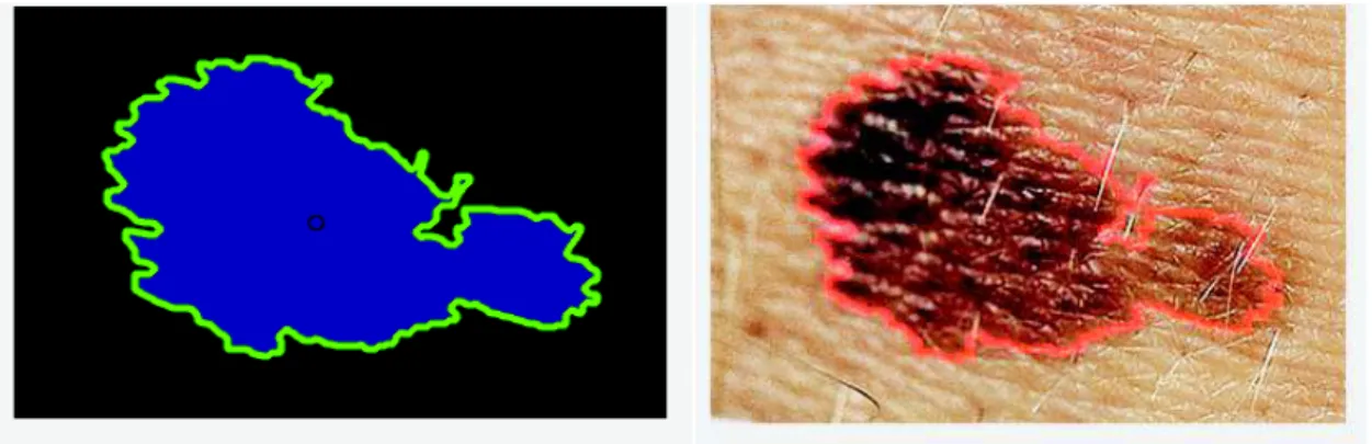 Figura 2.2. Proceso de Segmentación de las Imágenes Dermatoscópicas, Regla ABCD. 
