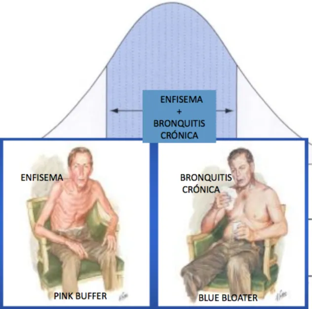 Fig	
  15.	
  Fenotipos	
  clínicos	
  pulmonares	
  clásicos	
  de	
  la	
  EPOC:	
  EPOC	
  tipo	
  A	
  (enfisema)	
  y	
  EPOC	
  tipo	
  B	
   (bronquitis	
  crónica).	
  Como	
  vemos	
  son	
  fenotipos	
  extremos	
  de	
  la	
  campana	
  de	
  Ga