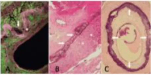 Figura 4. Imágenes microscópicas de los estados de MMS en  la  capa  media. 114   En  la  imagen  A  se  representa  el  estado  I  en  una arteria femoral con un microscopio de fluorescencia, 400x