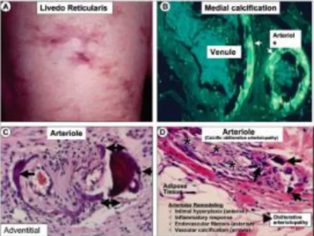 Figura 5. Repercusiones en la piel y hallazgos histológicos en la CUA. 42  A) cambios en la piel de la parte anterior de  la  pierna  izquierda  B)  Tinción  H&amp;E  en  la  que  se  aprecian  la  calcificación  medial  en  una  arteriola  y  vénula