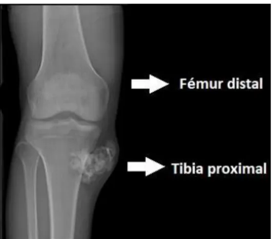 Figura 4. Radiografía de un osteosarcoma en el húmero proximal  d 2.3 Tipos de osteosarcomas 