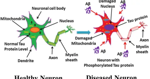 Figura 4. Comparativa entre una neurona sana i una neurona d'un pacient amb Alzheimer