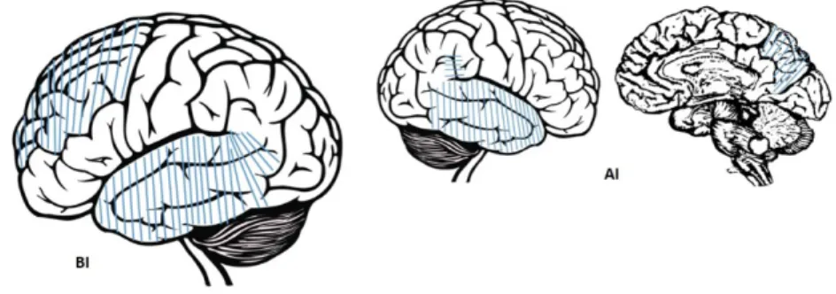 Figure 3. Cortex related to lexical access before (BI) and after an  intervention (AI)