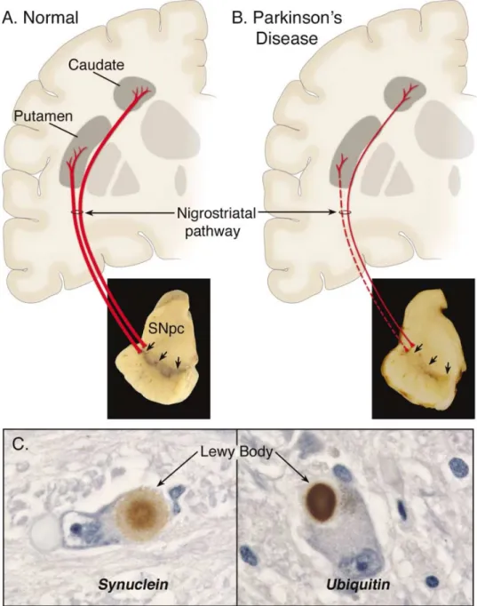 Fig 2: Neuropatología de la enfermedad de Parkinson (Dauer &amp; Przedborski, 2003). 