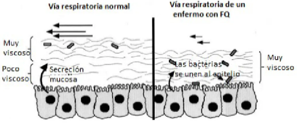 Figura 2. Comparación de la depuración mucociliar en las vías respiratorias normales y en vías respiratorias de pacientes con FQ