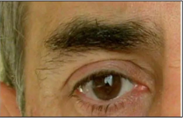 Figura 10. Aspecto horizontal de las cejas masculinas, que hay que respetar en los tratamientos  con toxina botulinica A