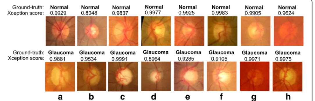 Fig. 7  Examples of correct normal and glaucoma classification. Samples of well‑classified normal and  glaucoma images by the Xception architecture