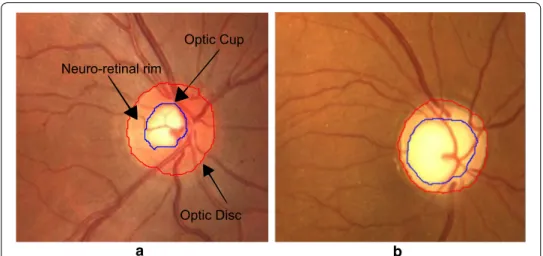 Fig. 1  Digital fundus images cropped around optic disc. a Main structures of a healthy optic disc and b  glaucomatous optic disc