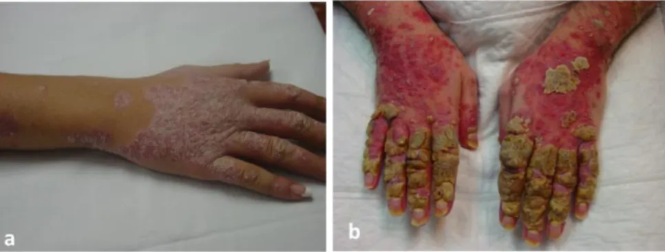 Figura  6a:  Placas  eritematosas  y  descamativas  de  la  PS  localizadas  en  el  dorso  de  la  mano  derecha