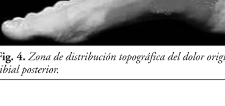 Fig. 4. Zona de distribución topográfica del dolor originado en el tibial posterior.
