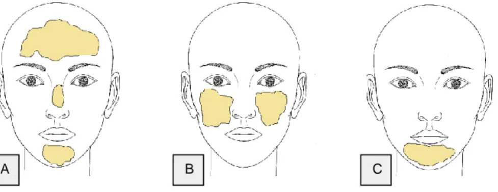 Figura 2: Patrones clínicos de distribución de la pigmentación; A) centrofacial, B) malar,  C) mandibular   