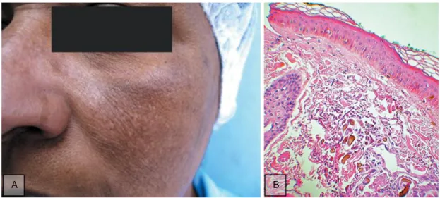 Figura 5: Imagen tomada de Charlín et al. A) Paciente con ocronosis exógena por tratamiento de su  melasma con hidroquinona al 5% durante 10 años; B) Imagen histológica que muestra las fibras 