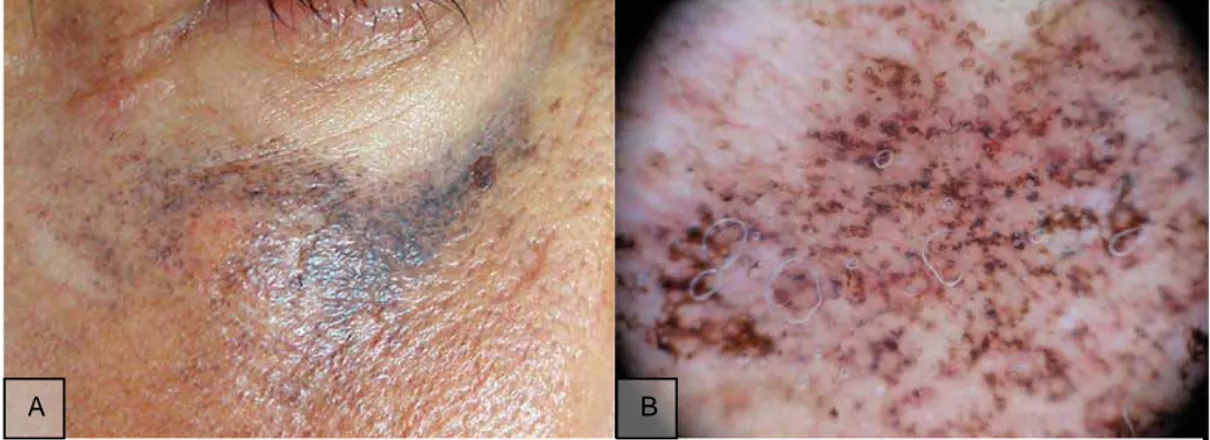 Figura 7: A) Máculas marrón grisáceas en las mejillas; B) Dermatoscopia mostrando estructuras  globulares irregulares marrón-grisáceas alrededor de toda la lesión 24 .