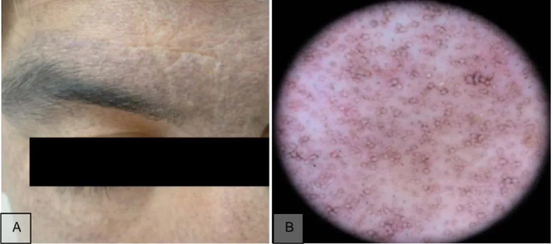 Figura 8: A) Hiperpigmentación maculosa grisácea de la cara de predominio supraciliar; 