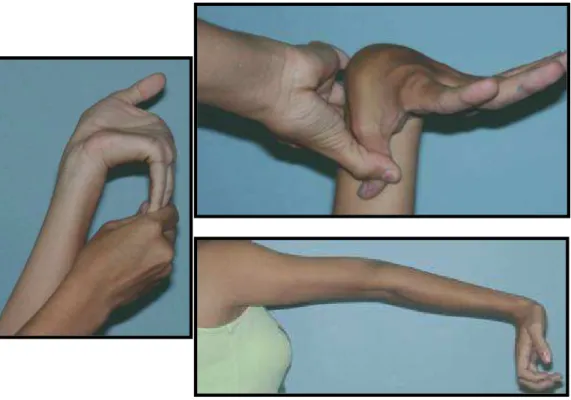 FIG. 1.2 Hipermovilidad articular. 