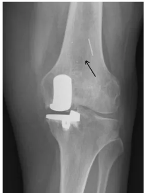 Fig. 1 Bearing dislocation in a UKA 10 months after surgery because of a mismatch between the tibial and femoral implants
