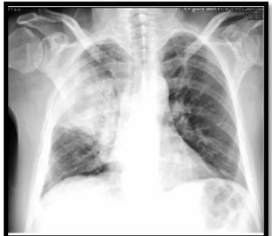 Figura  2.  Radiografía  AP  de  tórax  bien  inspirada y bien centrada 1