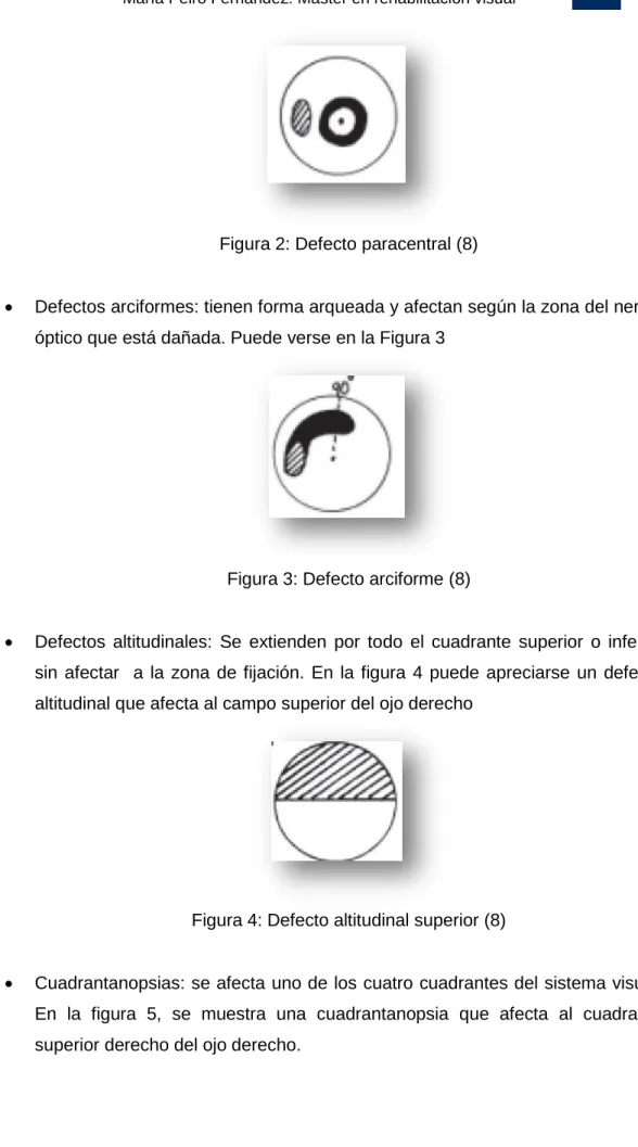 Figura 2: Defecto paracentral (8) 