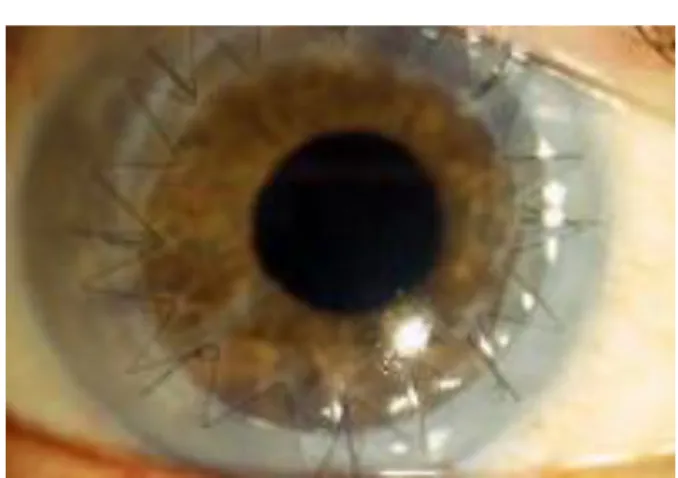Figura 12. Queratoplastia penetrante 15 . 