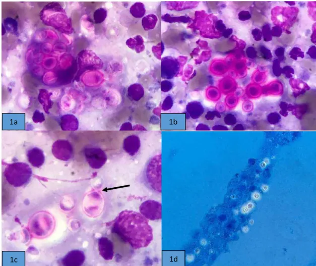Figura 1: (A) Estruturas redondas intracitoplasmáticas compatíveis com Cryptococcus  spp.