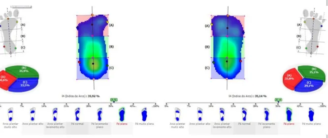 Figura 2- Distribuição de pressões por regiões do pé (antepé, mediopé, retropé) e tipologia do pé do indivíduo  sadio