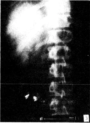Fig.  3.  Radiografía  del  tracto  biliar  que  muestra  opa­