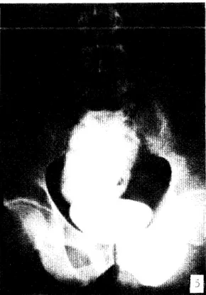 Fig.  4.  Radiografía  de  perfil  de  una  masa  quística  intra-abdominal  inyectada  con  el  medio  de  contras­