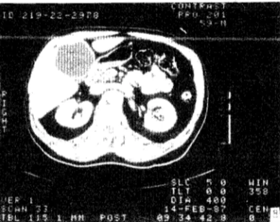 Fig.  8.  Tomografía  axial  computarizada  del  hígado  con  contraste  endovenoso:  nótese  un  quiste  en  el  área  media  inferior  del  lóbulo  derecho,  con  pared  gruesa  sin  calcificaciones