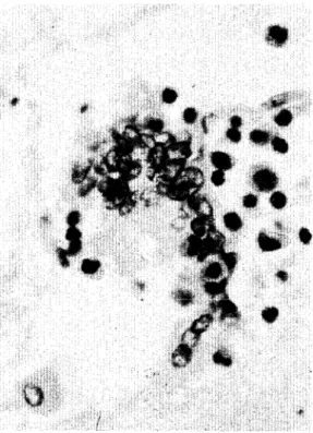 Fig.  14.  Grupo  de  células malignas  del  epitelio  de tran­